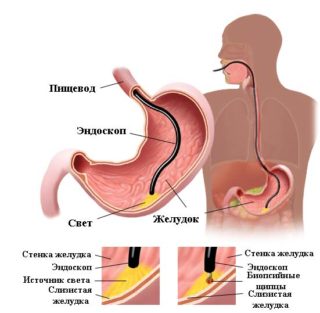 Почему при гастрите боль отдает в спину?