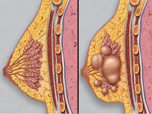 Типы доброкачественных опухолей груди