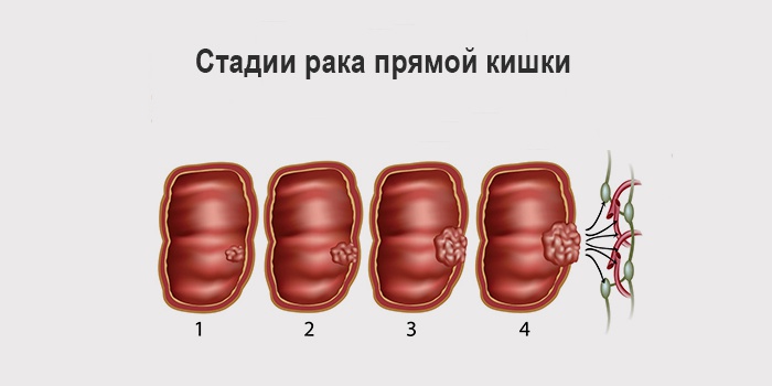 Рак прямой кишки: первые симптомы и признаки, диагностика, методы лечения