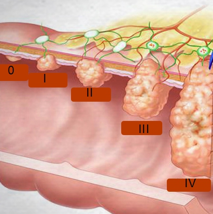 Стадии рака кишечника