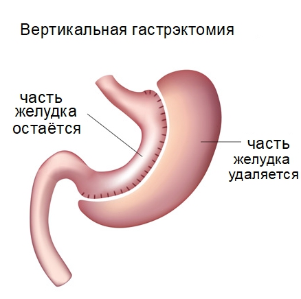 Гастрэктомия желудка