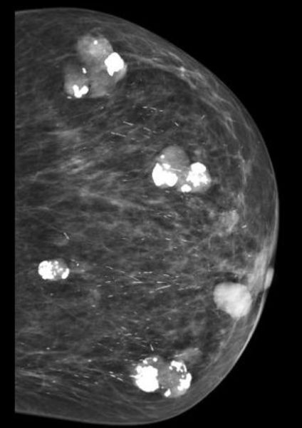 Фиброаденоматоз на маммографии