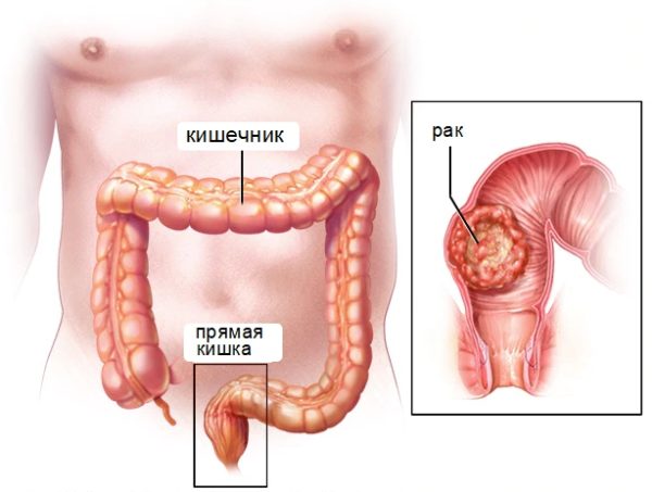 Аденокарцинома прямой кишки