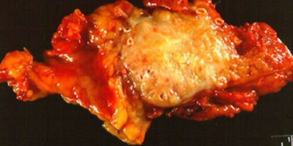 Рак в поджелудочной железе