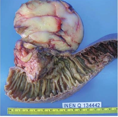 Повреждённая липоматозом поджелудочная железа