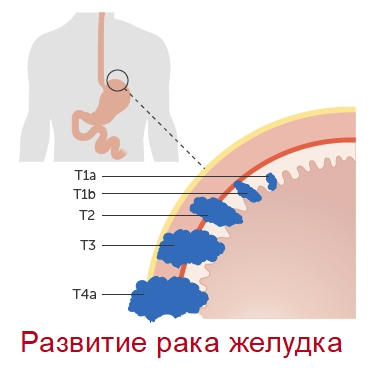 Развитие рака желудка