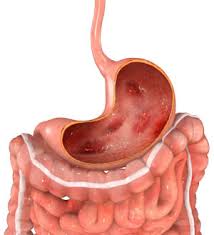 Желудок в язвах на слизистой