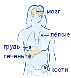 Метастазы от рака груди