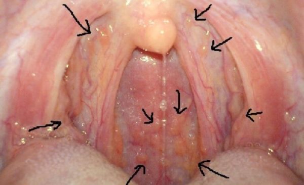 Симптомы рака горла