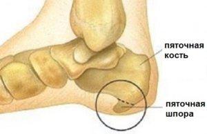 Шпора на пятке 
