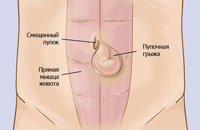 Образование пупочной грыжи