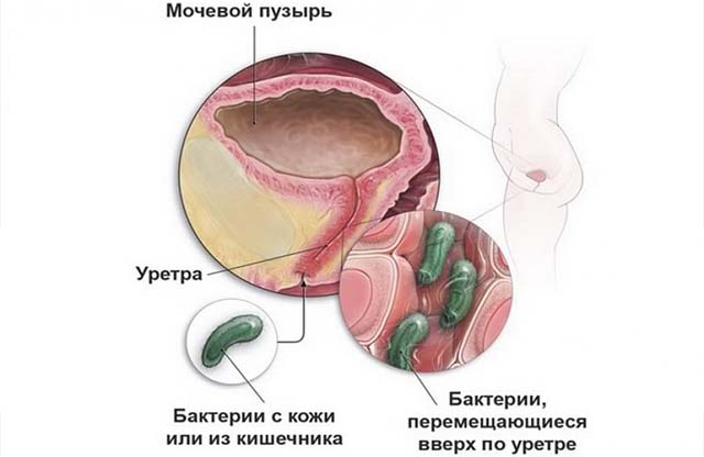 Мочевая инфекция