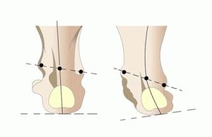 Деформация стопы