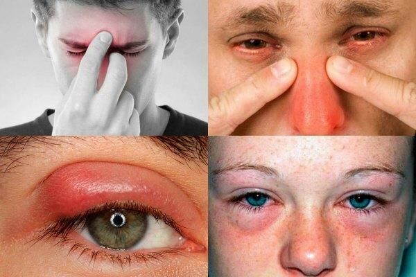 Причины боли глаз при простуде