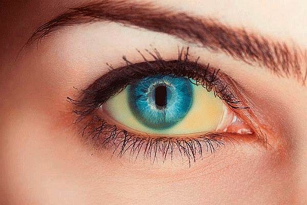 Белки глаз желтые
