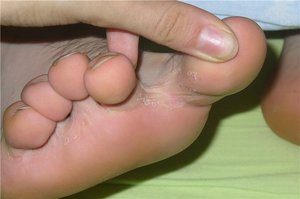 Чем может быть какой-то нарост на ногах между пальцами как мозоль