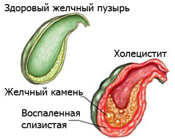 Схема здорового и воспаленного органов