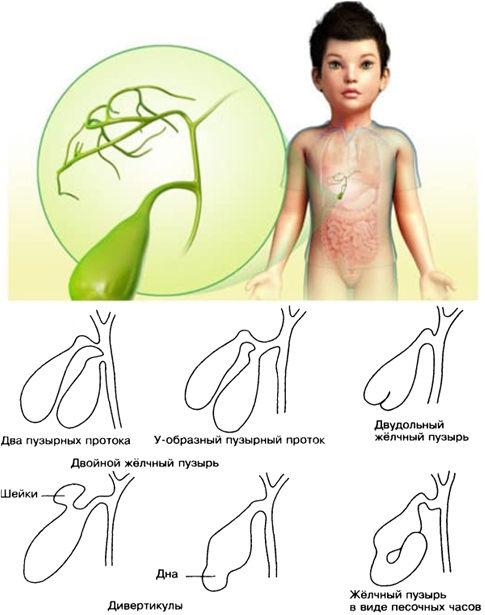 Перегиб желчного пузыря у детей