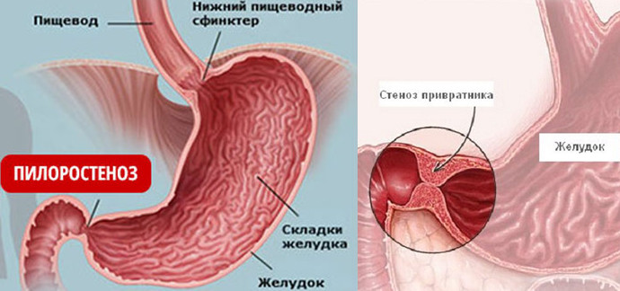 Стеноз привратника желудка