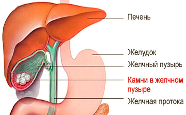 Анатомия желчнокаменной болезни