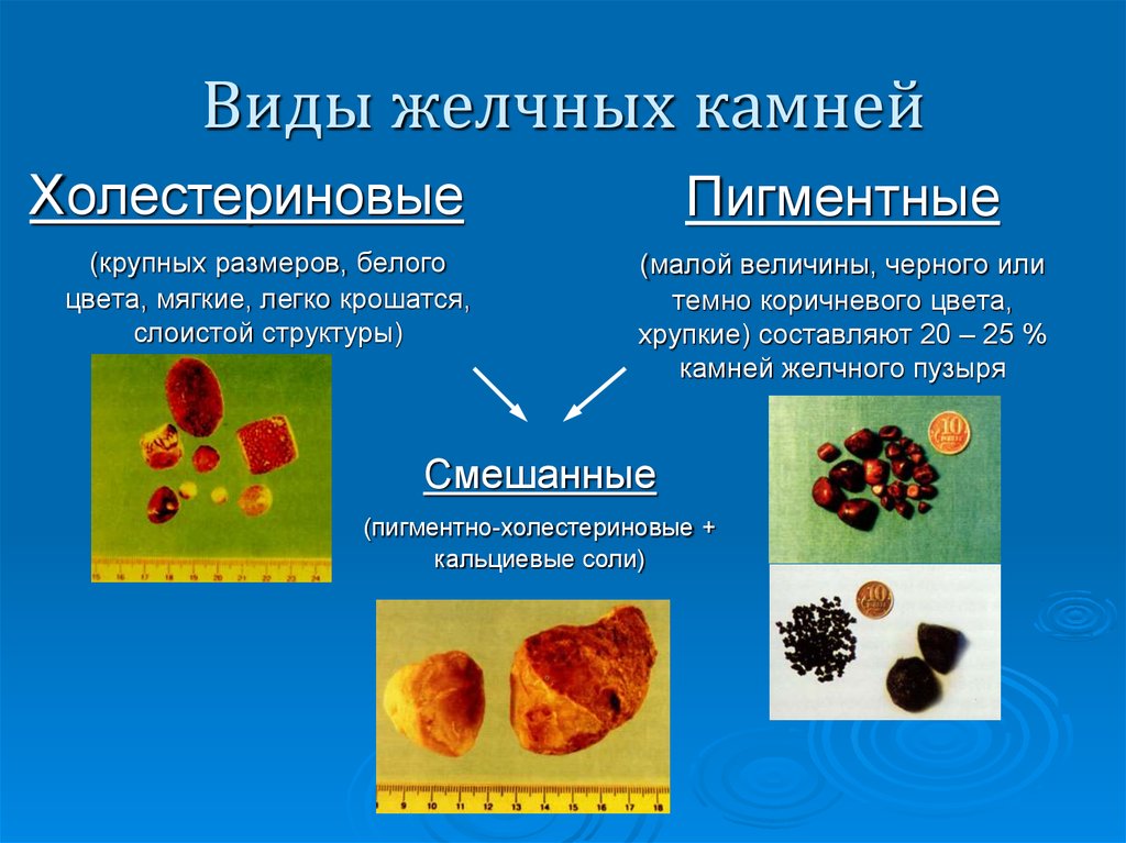 Виды желчных камней