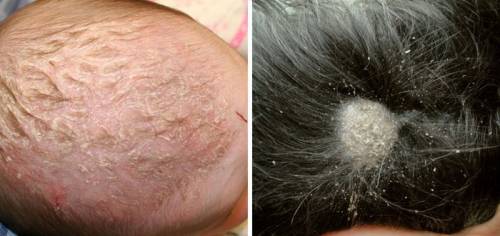 Заболевания кожи головы у ребенка и взрослого