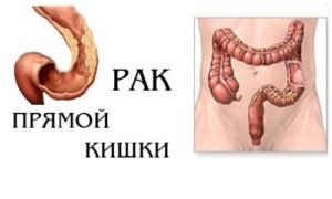 симптомы и признаки рака