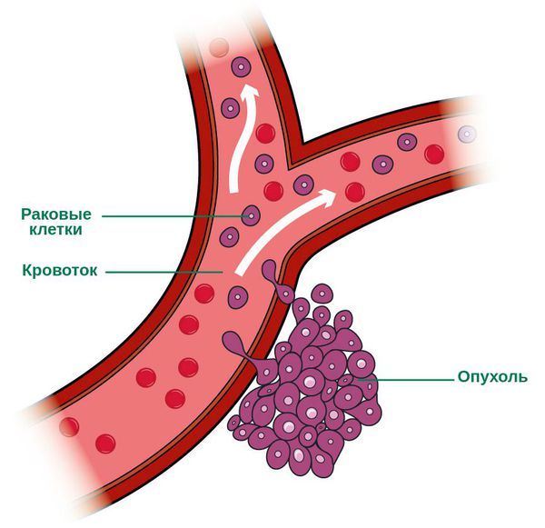 Распространение опухоли через кровоток