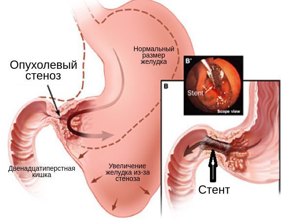 Стентирование опухолевого стеноза