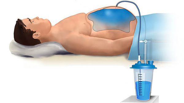 Удаление жидкости из брюшной полости
