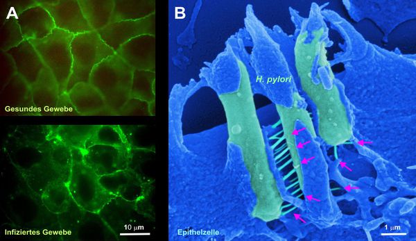 Здоровая и инфицированная ткань желудка (слева). H. pylori в ткани желудка (справа). Стрелочками указаны токсины, которые могут являться причиной рака