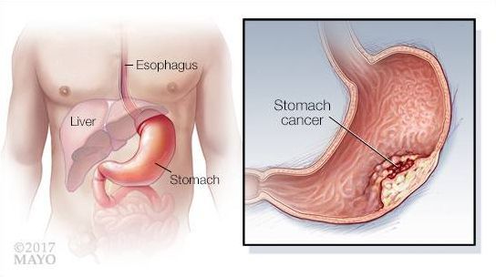 Злокачественная опухоль желудка