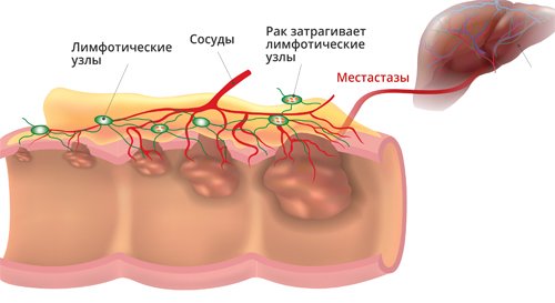 Опухоль кишечника