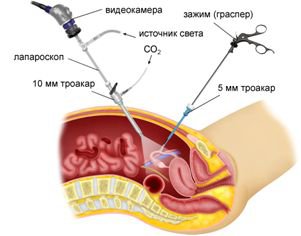 Диагностическая лапароскопия