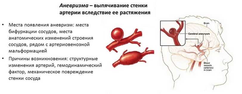 Аневризма сосудов головного мозга
