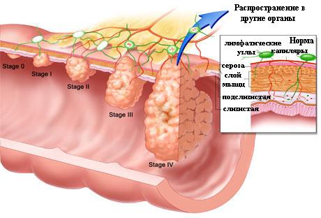 Стадии развития опухолей