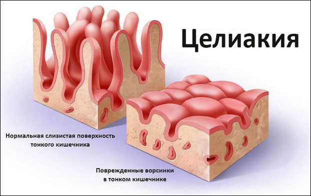 Целиакия