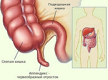 симптомы аппендицита у детей