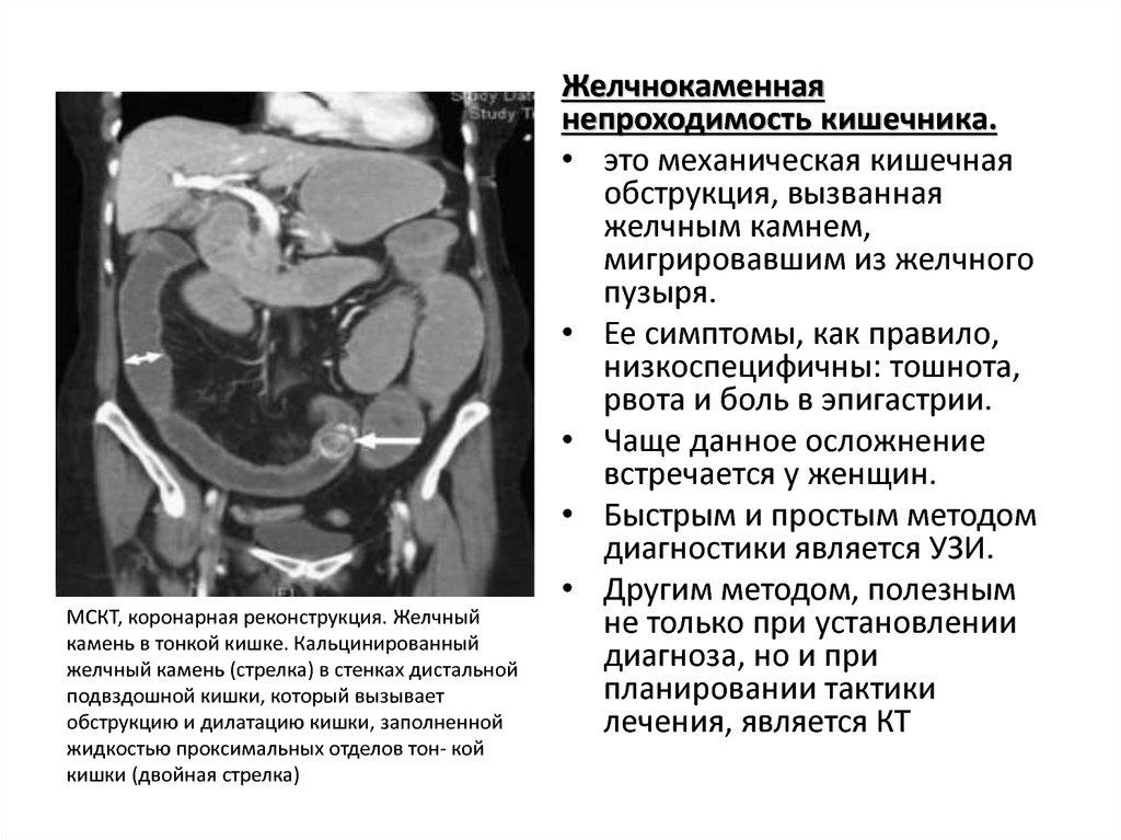 ЖКБ непроходимость кишечника - определение и анатомия