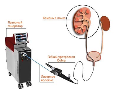 Лечение лазером камней в желчном пузыре