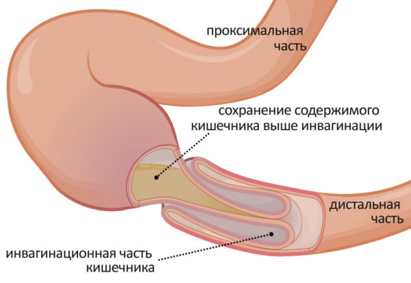 Желчные камни в кишечнике