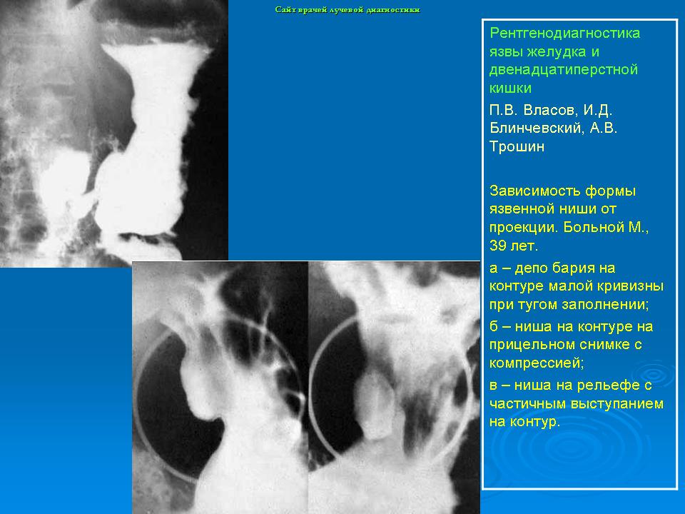 Язва 12 ти. Пенетрирующая язва желудка рентген. Перфоративная язва желудка рентген. Пенетрация язвы желудка рентген. Пенетрации язвы 12-перстной кишки на рентгене.