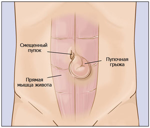 Симптомы пупочной грыжи