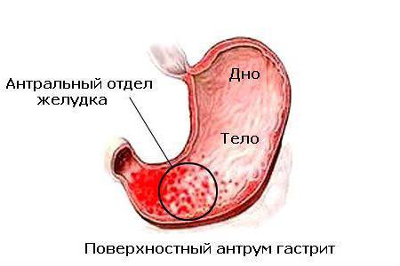 поверхностный антрум гастрит