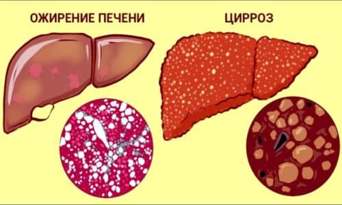 Эссенциале Форте эффективен при жировом гепатозе и множественном поражении печени