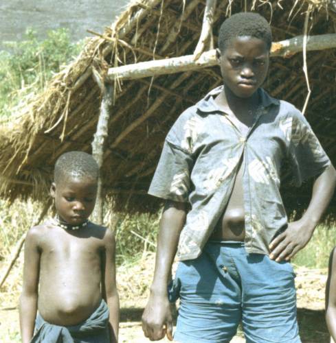 Дети с пупочной грыжи. Снимок сделан возле Kakoya, Сьерра-Леоне