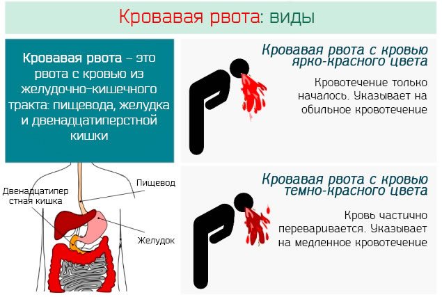 Кровавая рвота – это рвота с кровью из желудочно-кишечного тракта: пищевода, желудка и двенадцатиперстной кишки