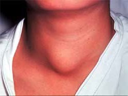 узловой зоб щитовидной железы лечение