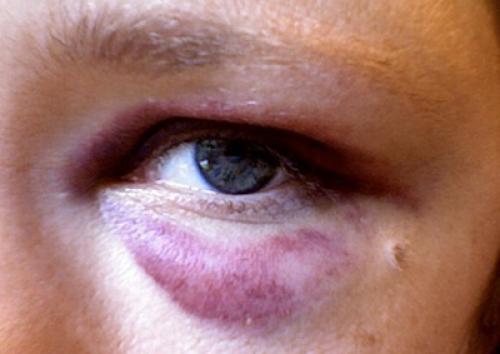 Как снять опухоль с глаза после удара в домашних условиях. Методы быстрого избавления гематомы глаза после удара: лечение медикаментами и народными средствами