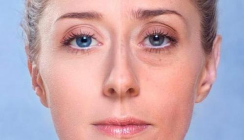 Опухшие глаза после блефаропластики. Отеки после блефаропластики: причины возникновения и способы устранения недуга